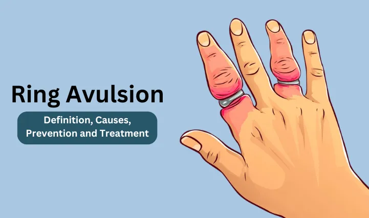 Ring avulsion definition, causes, Prevention and treatment