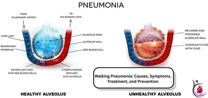 Walking Pneumonia